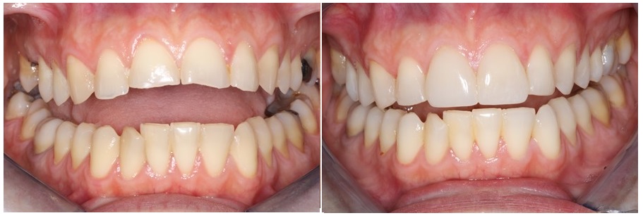 Διάβρωση δοντιών- πριν και μετά την προσθετική αποκατάσταση