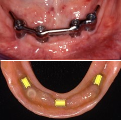 επένθετη οδοντοστοιχία κάτω γνάθου στηριγμένη σε δοκό και οδοντικά εμφυτεύματα