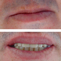 μεταλοκεραμική εργασία σε οδοντικά εμφυτεύματα πριν και μετά