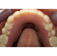 επένθετη οδοντοστοιχία άνω γνάθου στηριγμένη σε εμφυετύματα δοντιών